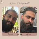 کاشت مو و ابرو با پرداخت 8 تومن و قسطی