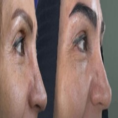کاشت مو و ابرو با جدیدترین روش‌ها
