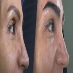 کاشت مو و ابرو با جدیدترین روش‌ها