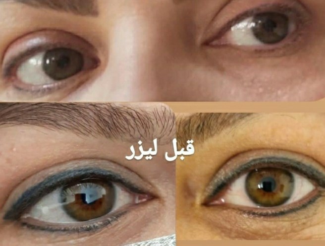 پاک کردن تاتو / پاک کردن تتو با لیزر در مشهد