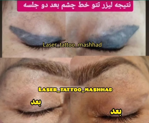 پاک کردن تاتو / پاک کردن تتو با لیزر در مشهد