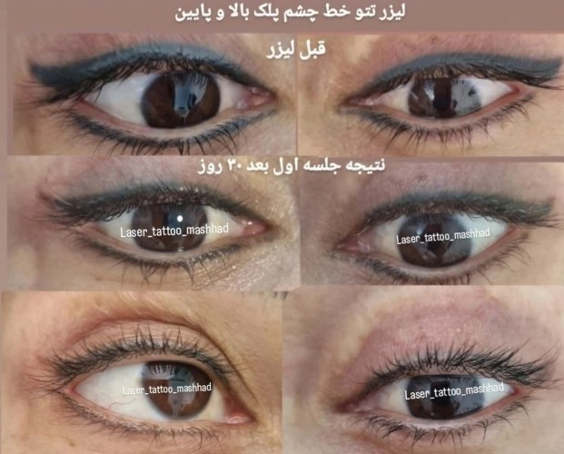 پاک کردن تاتو / پاک کردن تتو با لیزر در مشهد