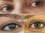پاک کردن تاتو / پاک کردن تتو با لیزر در مشهد